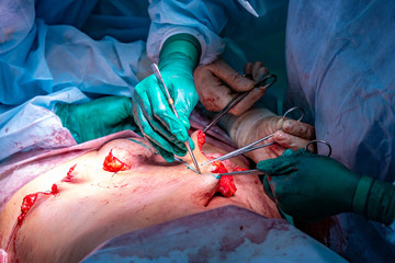 Surgical operation abdominoplasty
