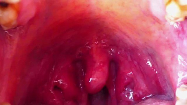 tonsil inflammation, a human's tonsils,
