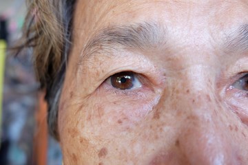 Close up Cataract or pterygium eye Asian Elderly woman
