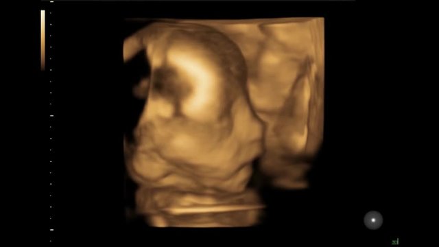 A 3D ultrasound imaging of a fetus