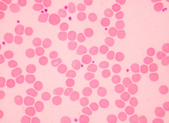 Fototapeta na wymiar Normochromic nomocytic red blood cells.