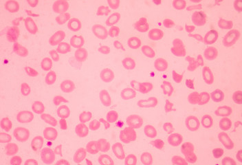 Thalassemia blood smear abnormal red blood cells morphology.