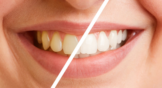 Vergleich von Zähnen vor und nach Zahnreinigung