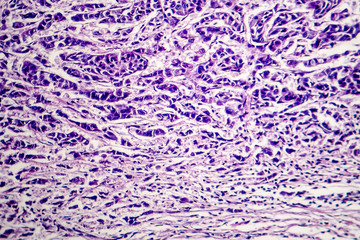 Lymph node cancer, light micrograph, photo under microscope