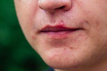 Fototapeta premium pimples on the face of a man close-ups