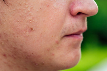pimples on the face of a man close-ups