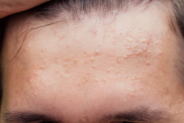 pimples on the face of a man close-ups