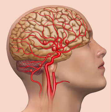 Descriptive illustration of the development of the human cerebral aneurysm
