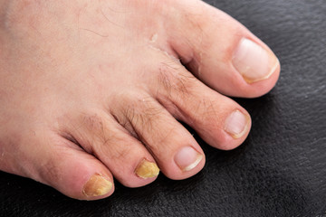Close-up with male fungal disease male toenails.