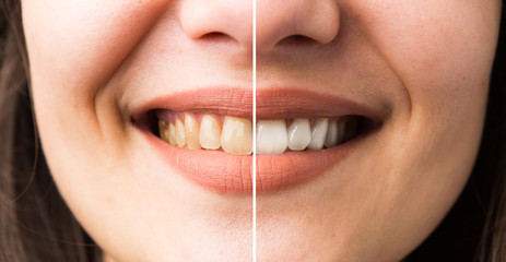 Woman smile before and after bleaching
