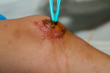 Cleaning wounds