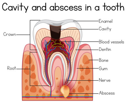 Cavity and Abscess in a Tooth