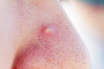 Fototapeta premium close up of facial acne
