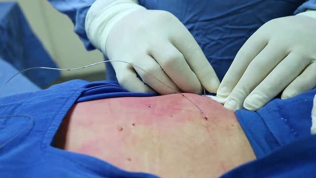 Procedure of discplasty with oszono and plasma with platelets