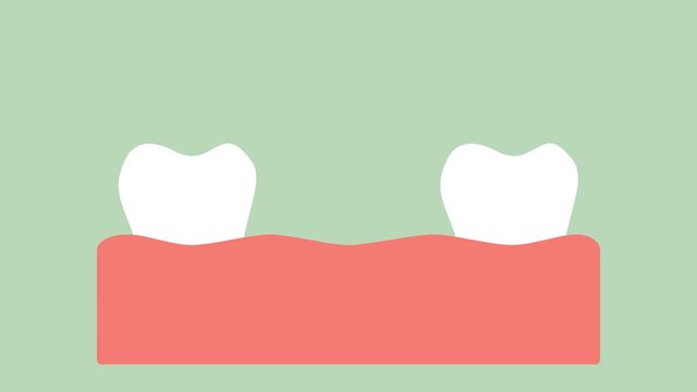 dental implant, installation process and change of teeth - dental cartoon vector flat style render 2d animation in 4K