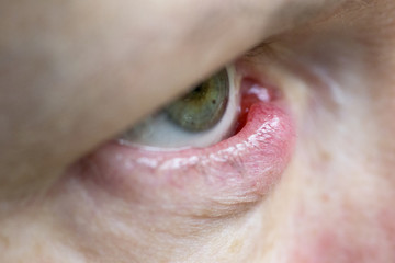 Naklejka premium Chalazion Eye 3 side