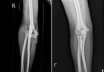 Film elbow AP showed fracture of elbow,Film elbow AP showed dislocation of elbow.