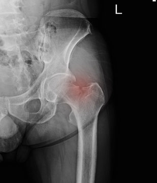 X-ray left hip : fracture left Neck of femur ( Thigh bone ).