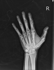 X-ray Hand AP,OBLIQUE: Post fix fracture second metacarpol bone with plate and screws.