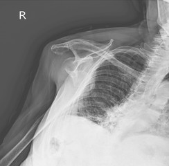 X-ray Shoulder a female 97 year old.Anterior dislocation right shoulder joint.