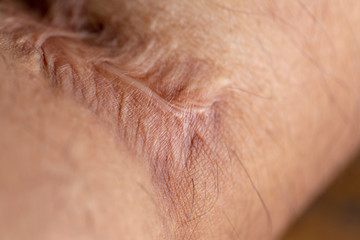 Scar on skin arm.