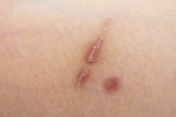 Scar on skin arm.