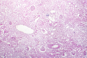 Tubular epithelial edema, light micrograph, photo under microscope