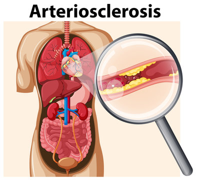 Human Body with Arteriosclerosis
