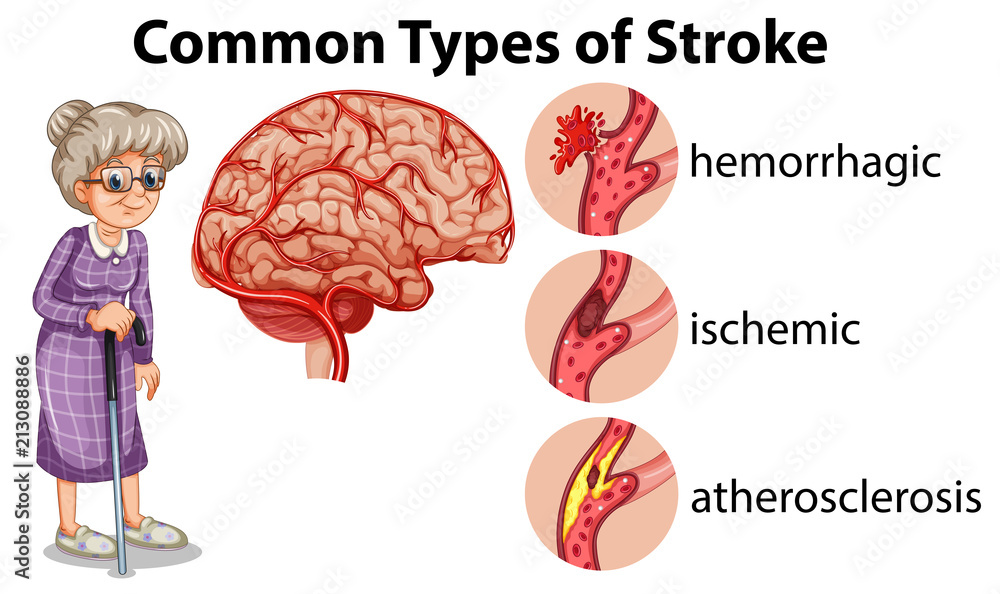 Canvas Prints common types of stroke