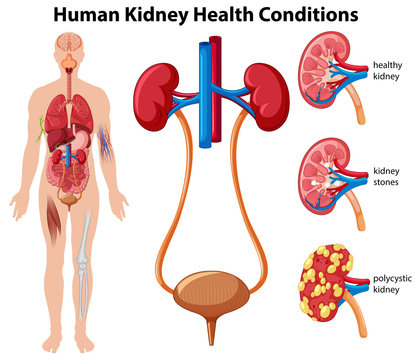 Human Kidney Health Conditions