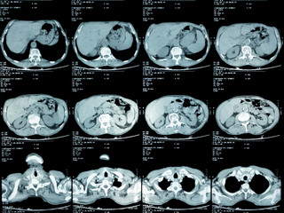 film x-ray of chest , lung cancer from patient who love smoking cigarette , health concept