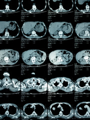 film x-ray of chest , lung cancer from patient who love smoking cigarette , health concept