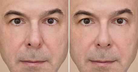 Male nose before and after plastic surgery