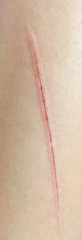 Fototapeta premium red scar on skin