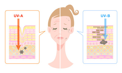紫外線による肌荒れに悩む女性の顔と、紫外線A波とB波の悪影響の説明図