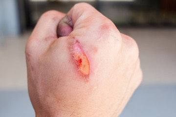 burning pain wound from burn on man's hand,