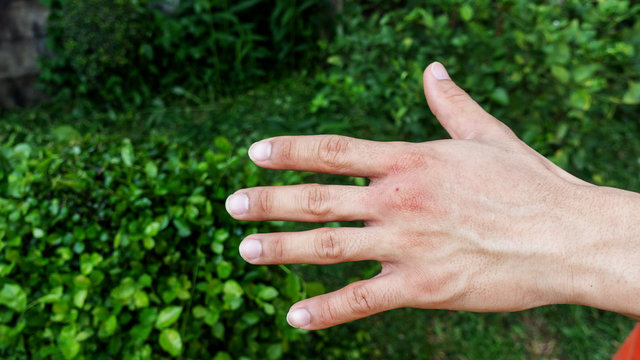 Men were bitten by an insect.