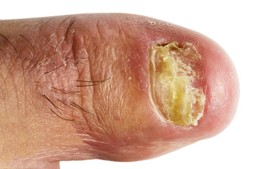 finger nail  with fungal infections onychomycosis , white background