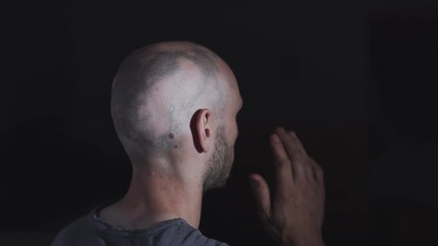 Alopecia Bald Patches Back of head