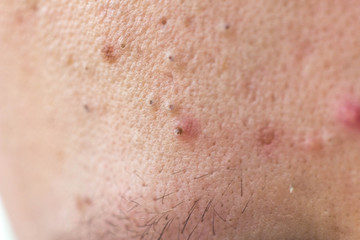 Black dots on face and pimples macro, comedo