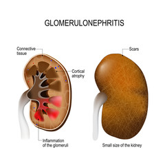 Fototapeta premium Glomerulonephritis.