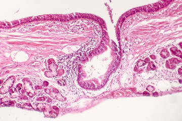 Squamous metaplasia of bronchial epithelium, light micrograph, photo under microscope