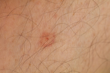 flea bite on human