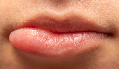 Orale Lippen Herpes Infektion, / Lippe aufgebissen.