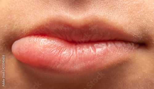 Orale Lippen Herpes Infektion Lippe Aufgebissen Stockfotos Und
