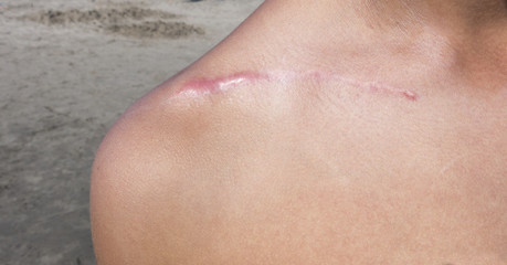 surgical scar over the scapula shoulder
