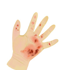 Wounded hand
