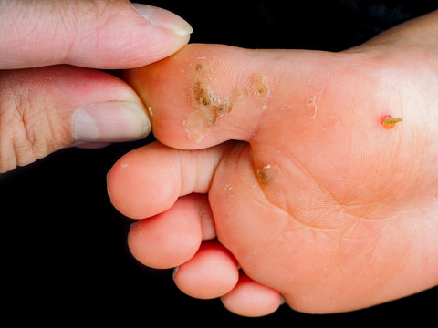 Child's foot sole, with verruca, wart,  callus isolated towards black. Touched by fingers of a pediatrician, doctor 