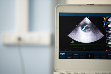 Photo of the screen of an ultrasound scanner with the image of a heart scan, where valvular regurgitation is assessed using the Doppler method.