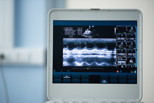 Photo screen ultrasound scanner with a picture of the heart scan.